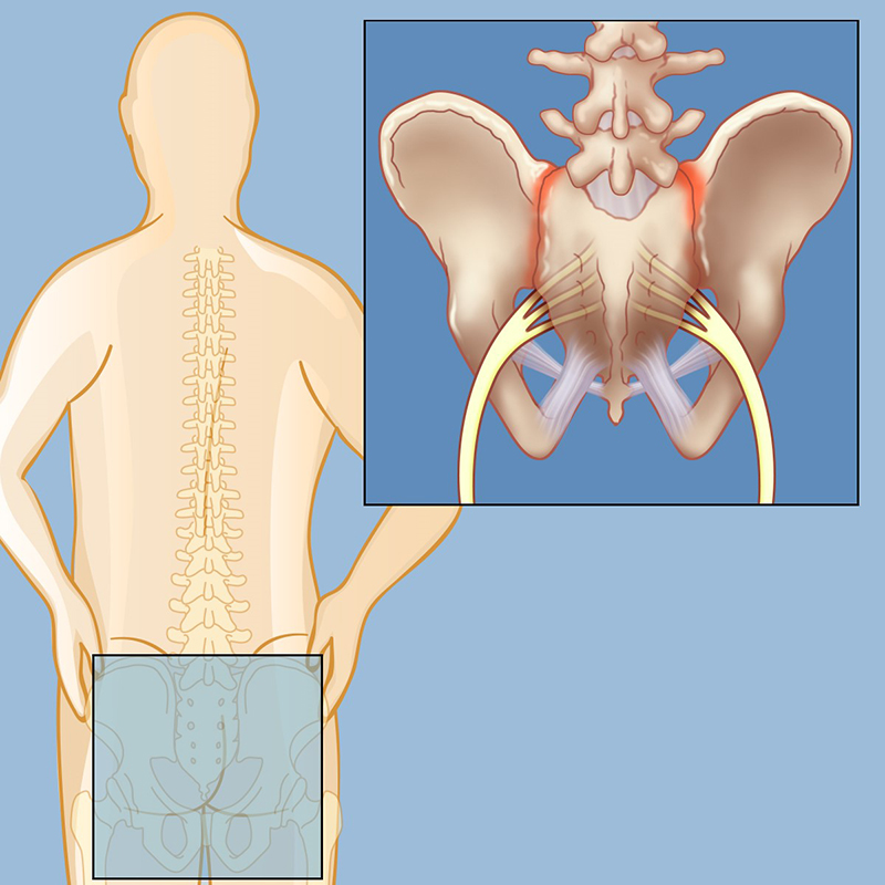 How Long Does A Sprained Sacroiliac Joint Take To Heal Damian Moore